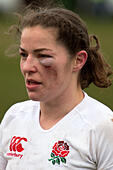 Emma Croker the England rugby hooker with a black eye 2.2.2013, Esher, - D2WGP3